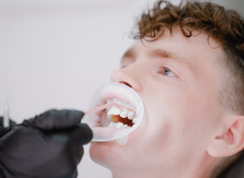 the hygienist doctor washes off the whitening solution from the teeth